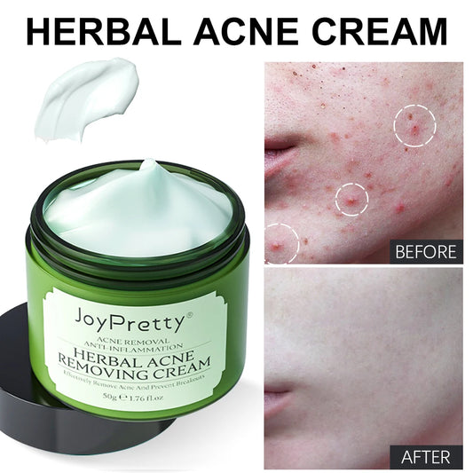 ClearGlow Herbal Acne Cream