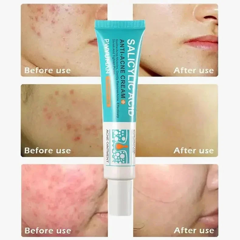 ClearSkin Salicylic Acid Acne Cream