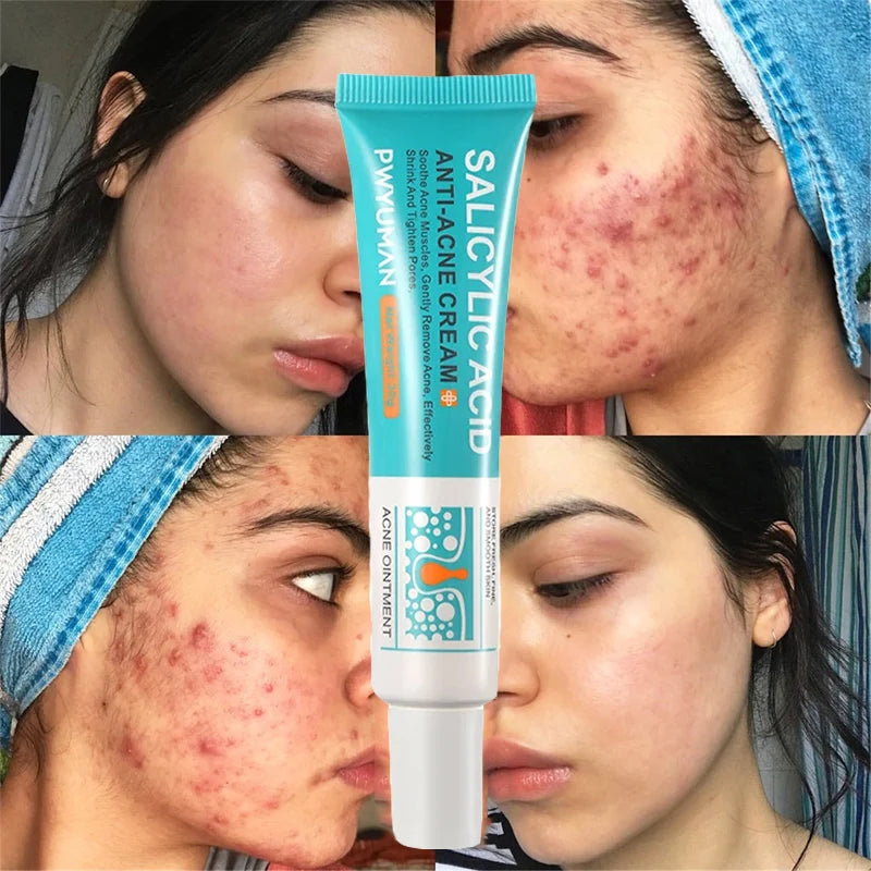 ClearSkin Salicylic Acid Acne Cream