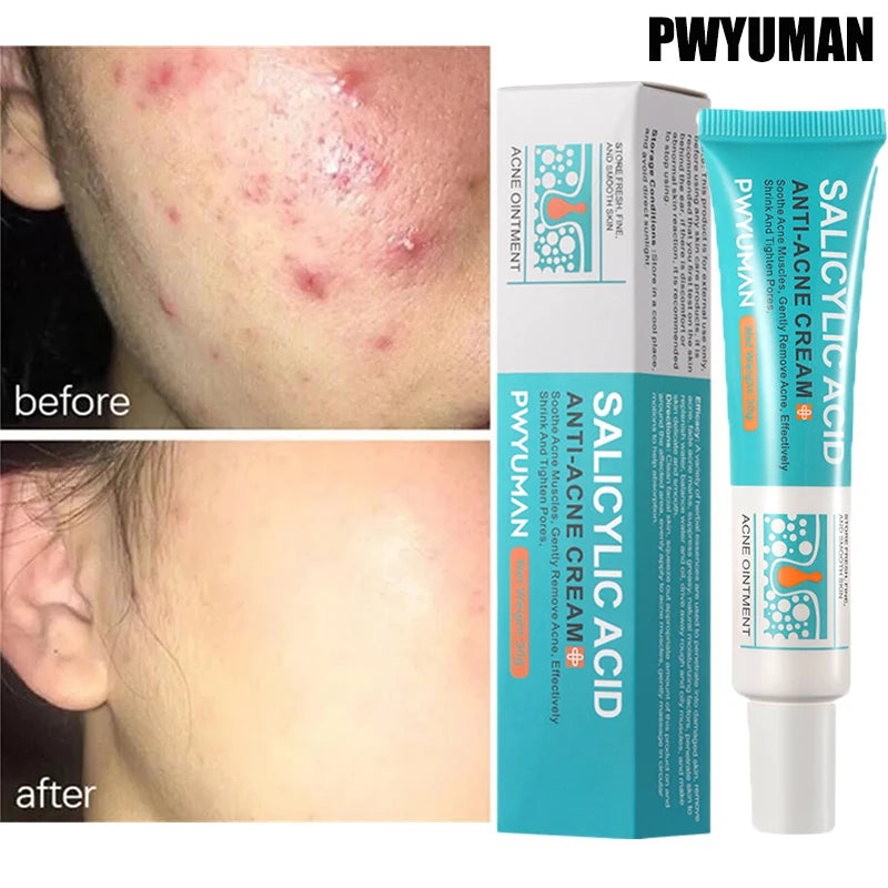 ClearSkin Salicylic Acid Acne Cream