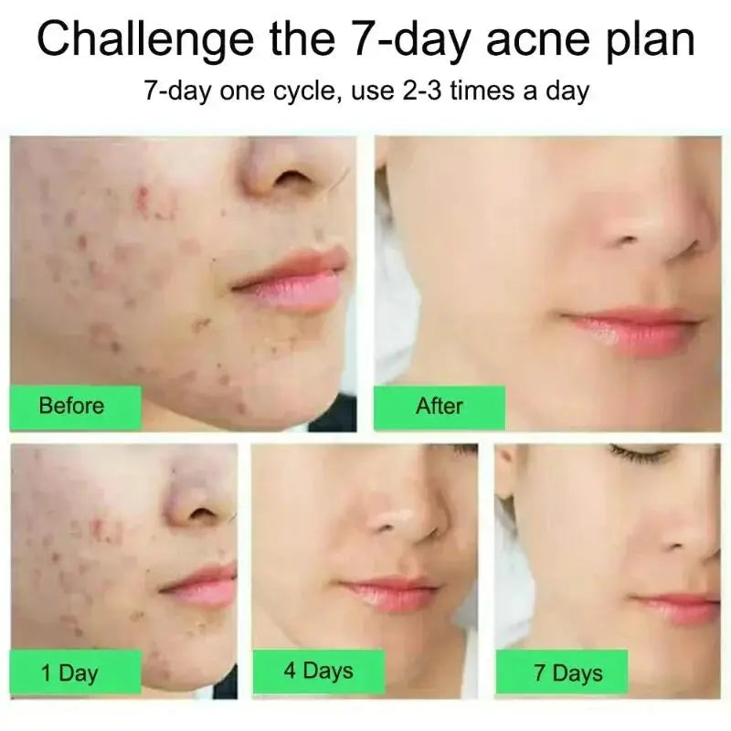 ClearSkin Salicylic Acid Acne Cream