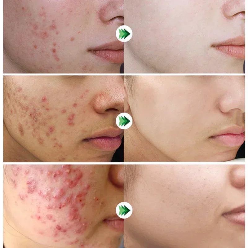 ClearSkin Salicylic Acid Acne Cream