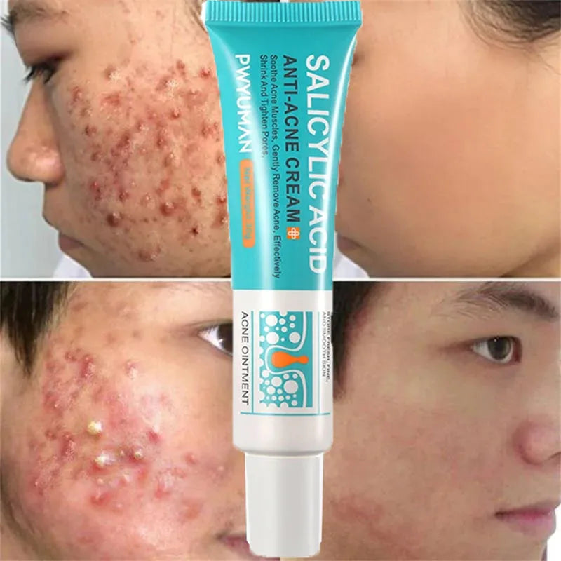 ClearSkin Salicylic Acid Acne Cream